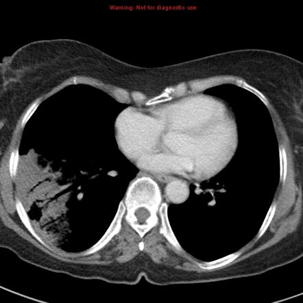 Bronchoalveolar carcinoma (BAC) | Image | Radiopaedia.org