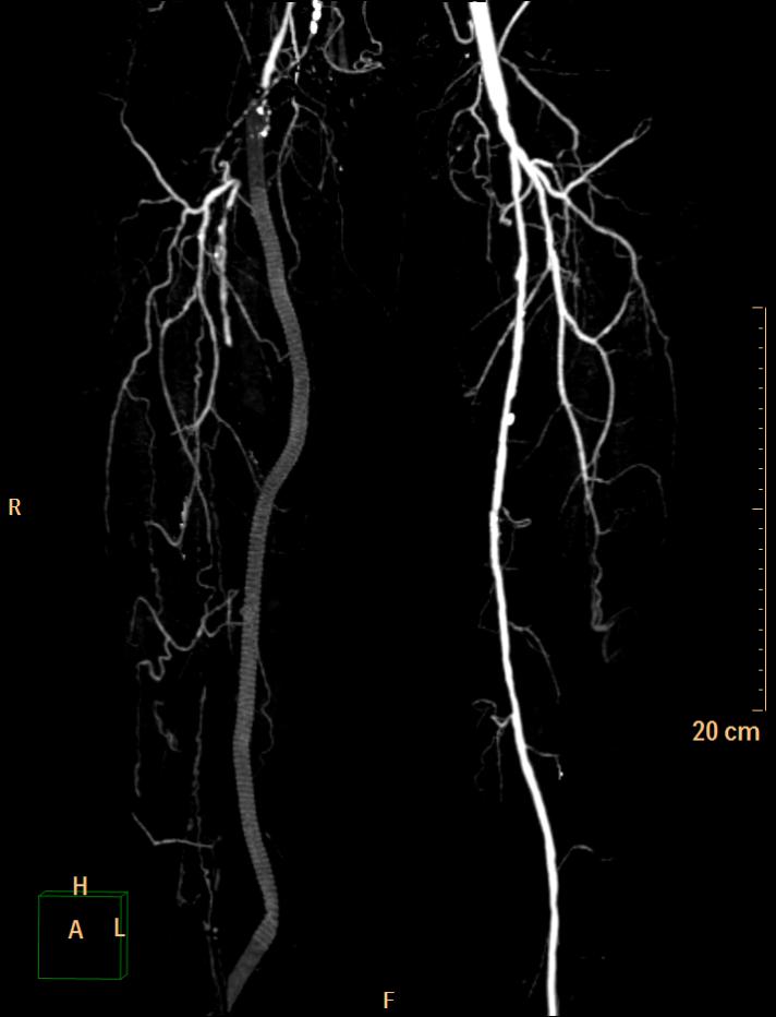 Aortobifemoral Bypass Graft Image