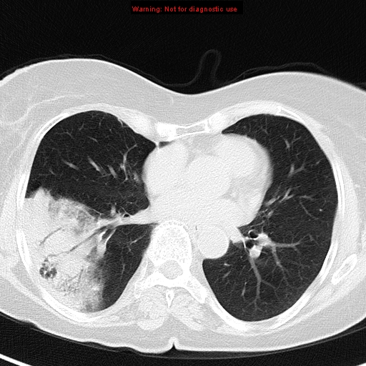 Bronchoalveolar carcinoma | Image | Radiopaedia.org