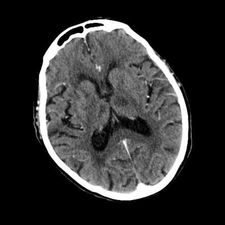 Thalamic infarct | Radiology Reference Article | Radiopaedia.org