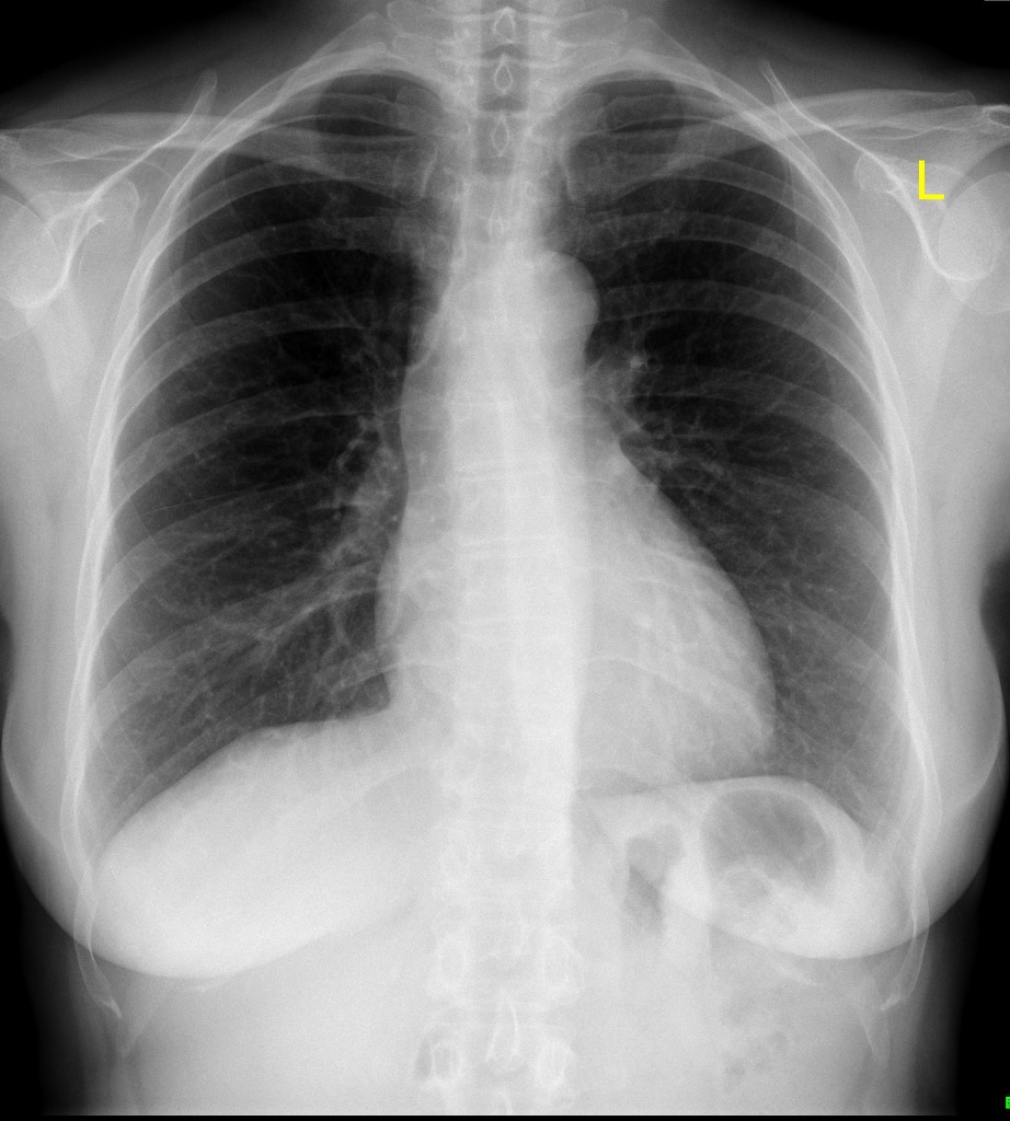 Neat How To Report Normal Chest X Ray Write A Good Introduction For Research