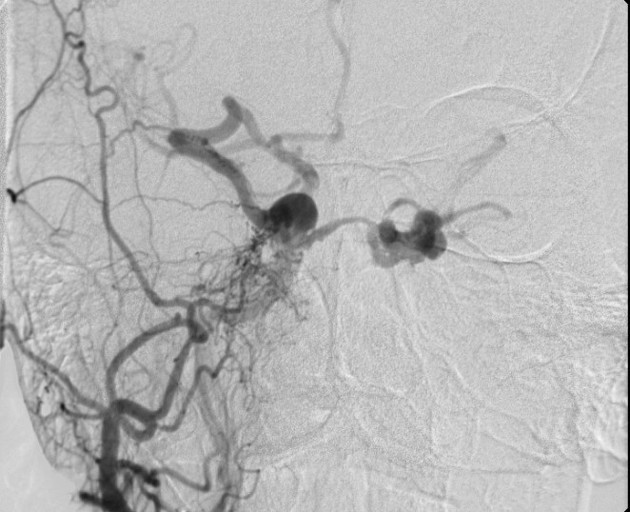 Figure 1: Dural arteriovenous fistula , (yap, 2019) (2)