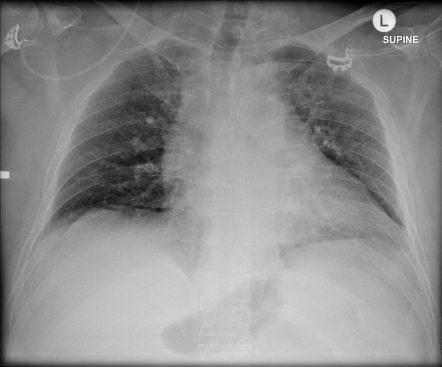 Chest radiograph | Radiology Reference Article | Radiopaedia.org