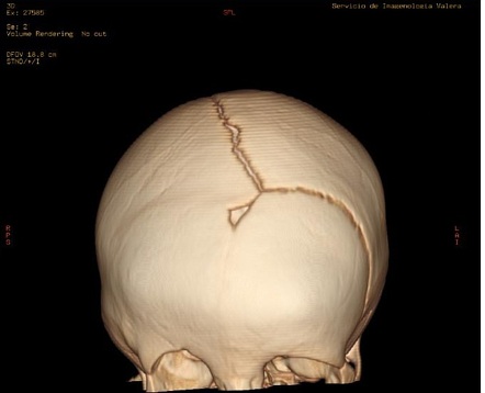 Plagiocephaly | Radiology Case | Radiopaedia.org