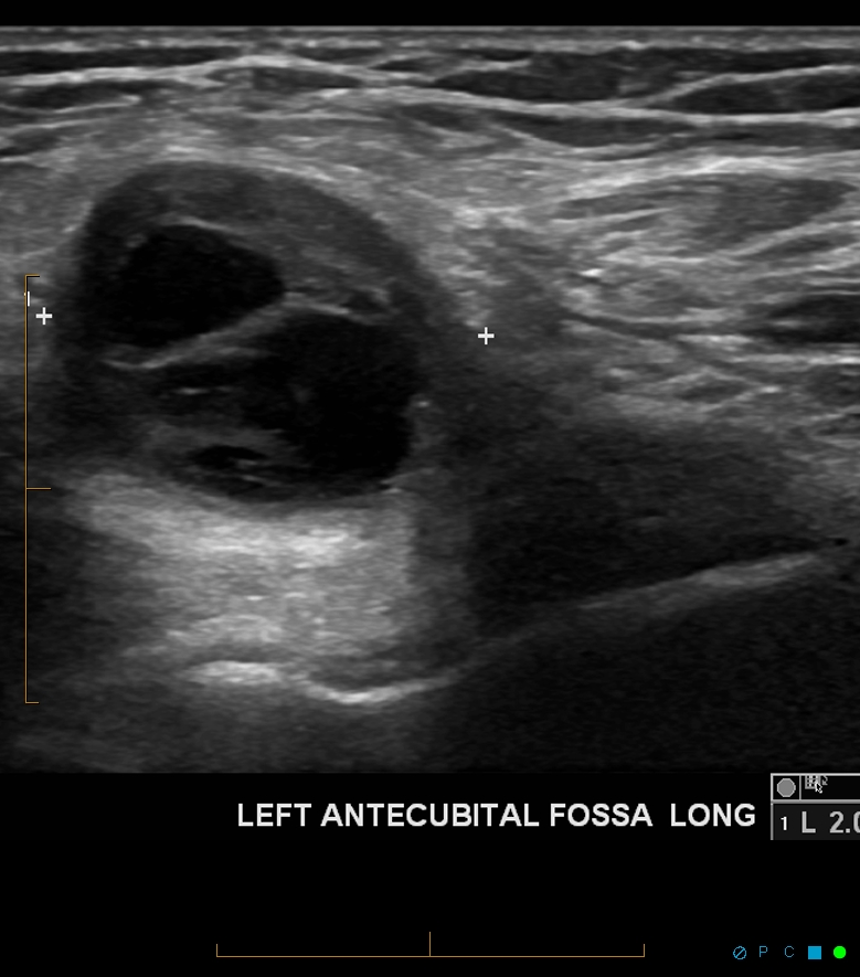 Cubital Bursitis Image