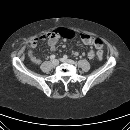 Spigelian hernia | Radiology Reference Article | Radiopaedia.org