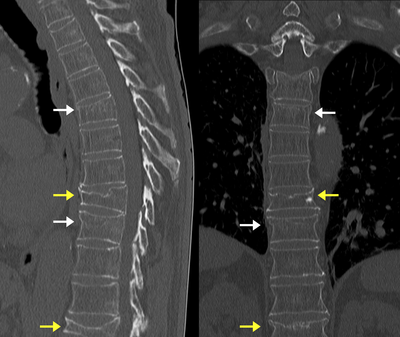 spinal-compression-fracture-acute-vs-old-radiology-case