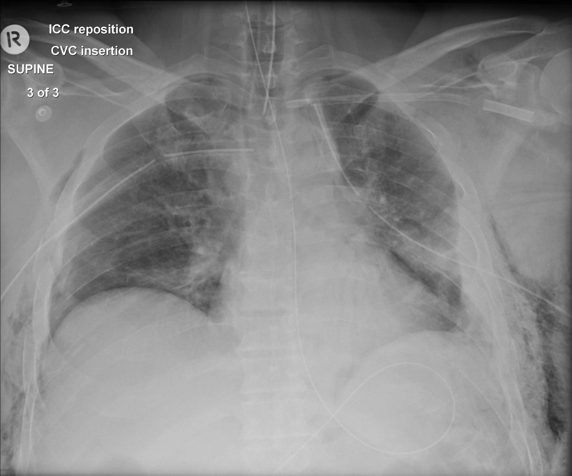 Chest crush injury | Image | Radiopaedia.org