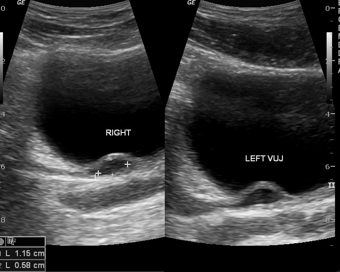 Ureterocele Fetal Ultrasound