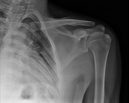 Greater tuberosity of humerus fracture | Radiology Case | Radiopaedia.org