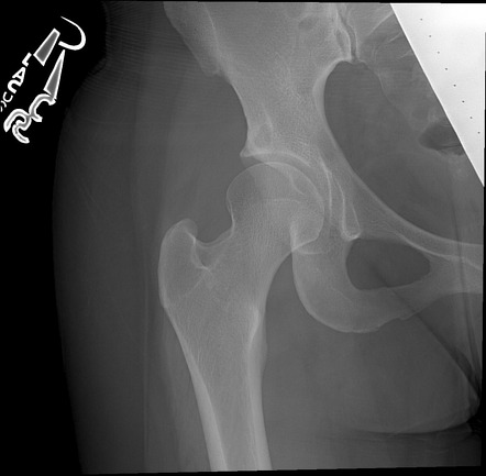 Primary cystic arthrosis of the hip | Image | Radiopaedia.org