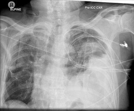 Diaphragmatic rupture | Radiology Reference Article | Radiopaedia.org