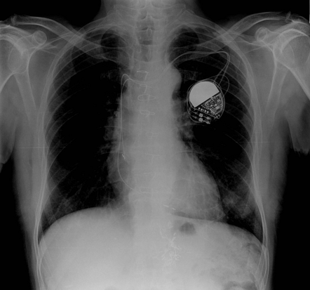 Highly selective vagotomy | Radiology Case | Radiopaedia.org