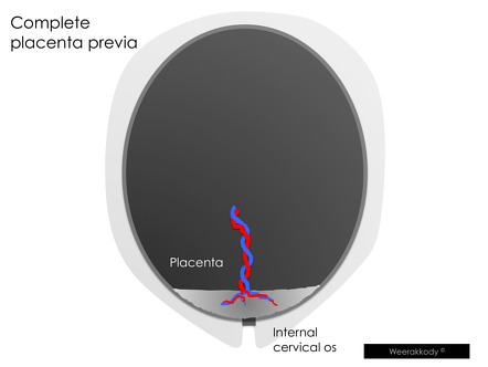 placenta fenestrata