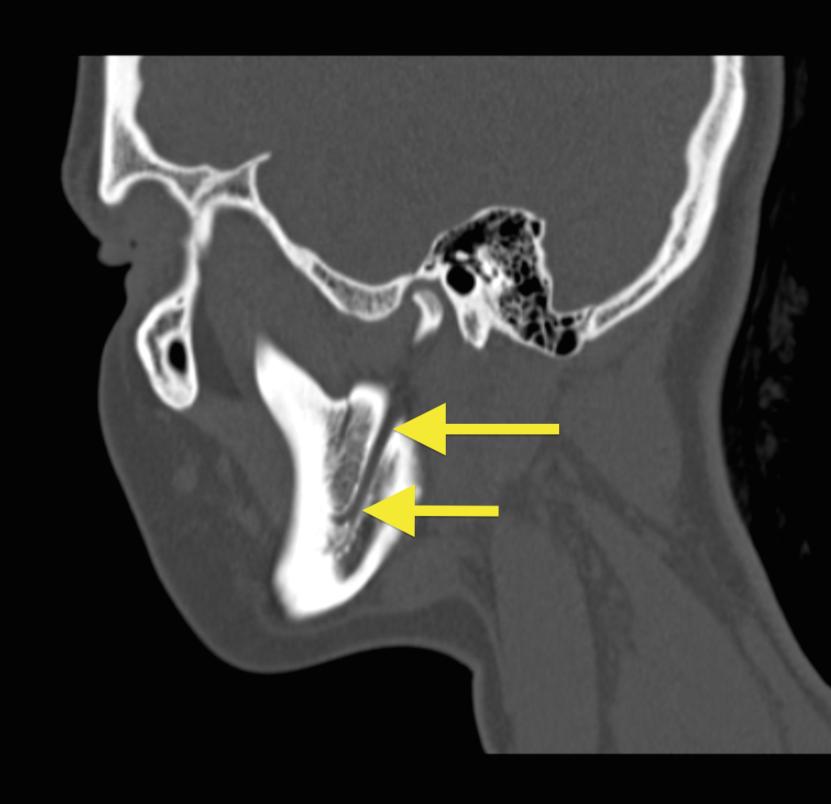 Mandibular canal | Image | Radiopaedia.org