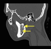 Inferior alveolar nerve, Radiology Reference Article