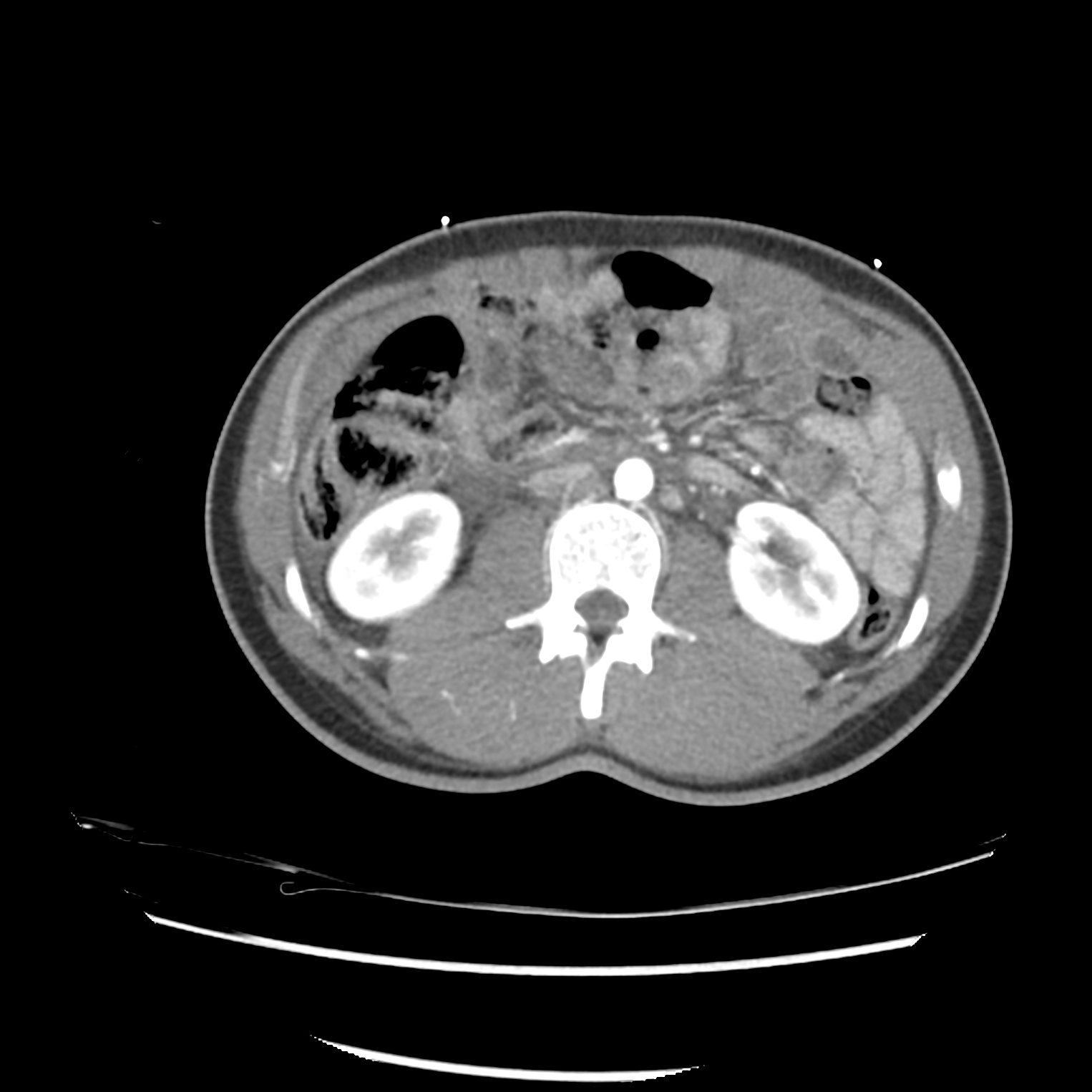 File:Splenic, small bowel and pelvic trauma (Radiopaedia 31656-32563 ...