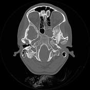 pterygopalatin sütür