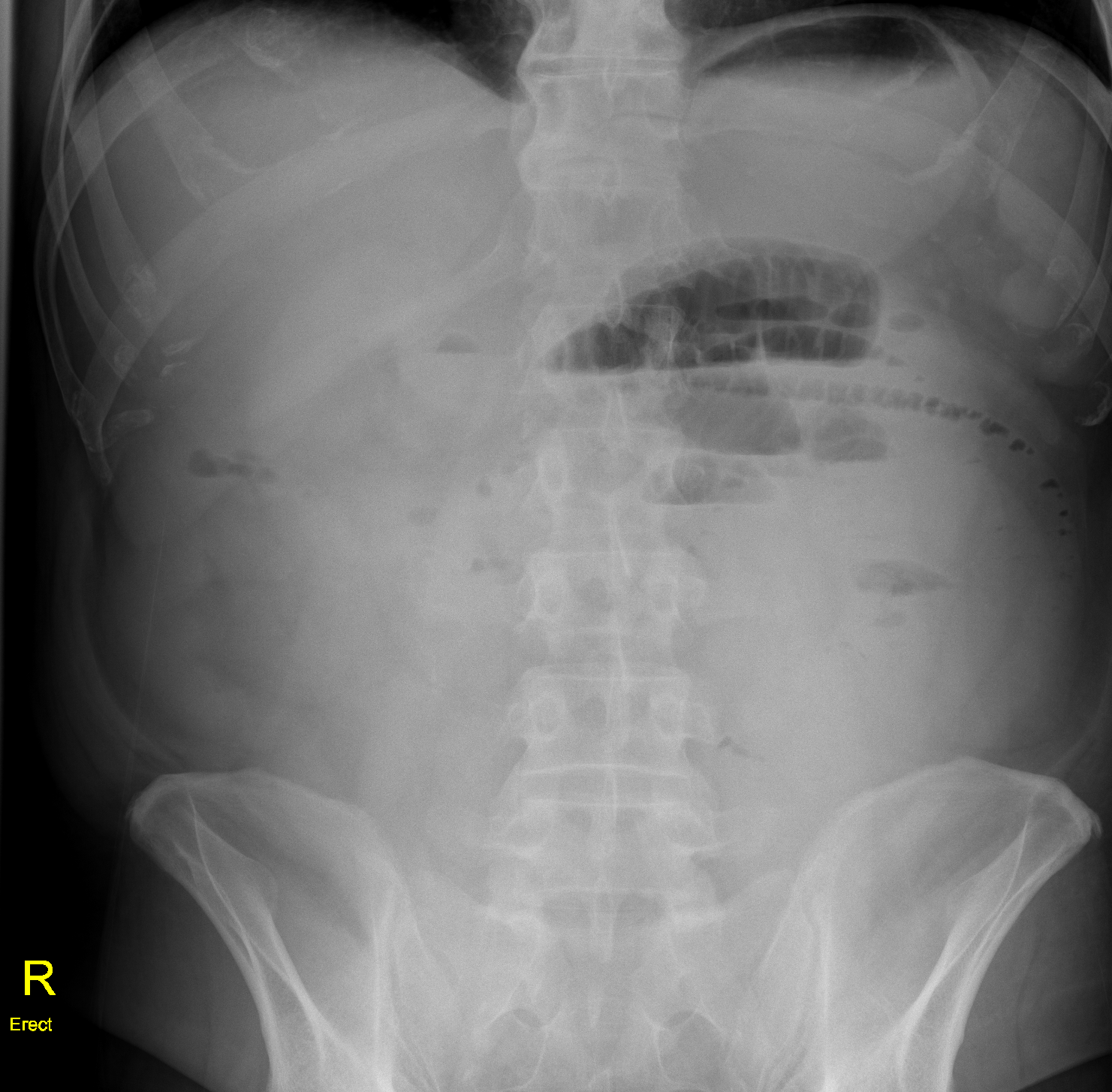 Adhesional small bowel obstruction | Image | Radiopaedia.org