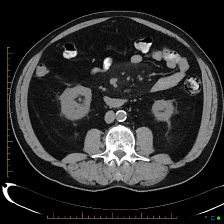 Sclerosing mesenteritis | Radiology Reference Article | Radiopaedia.org