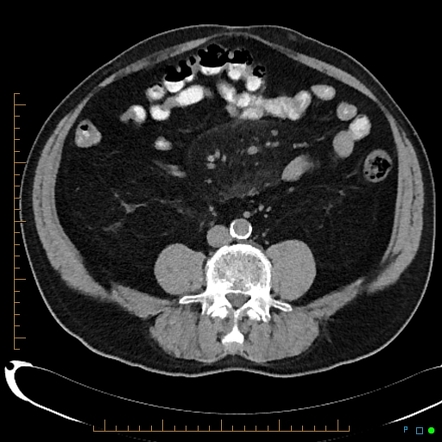 Fat Ring Sign (mesenteric Panniculitis) 