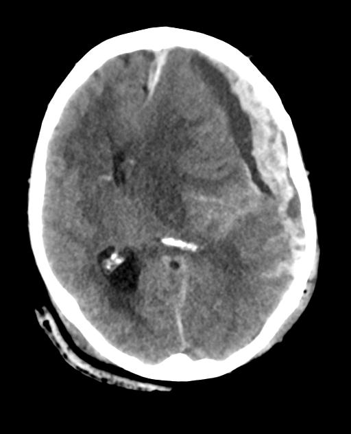 Acute on chronic subdural hematoma and thoracic vertebral injury in a ...