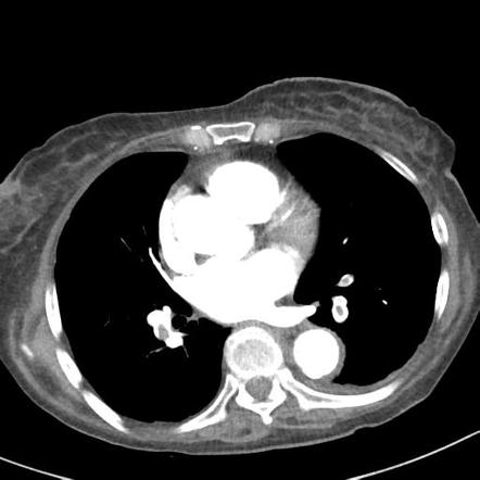 Pulmonary emboli with right heart strain | Image | Radiopaedia.org