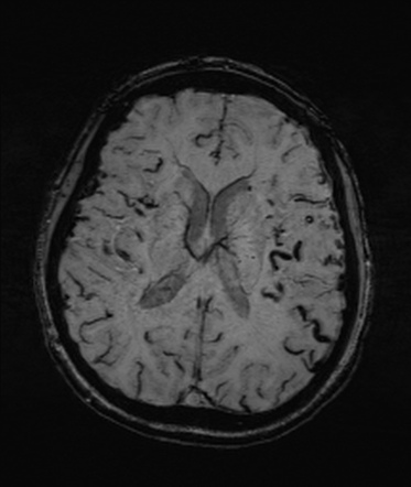 Dural Arteriovenous Fistula | Image | Radiopaedia.org