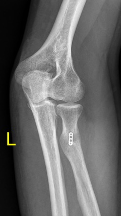 Distal biceps brachii tendon repair | Image | Radiopaedia.org