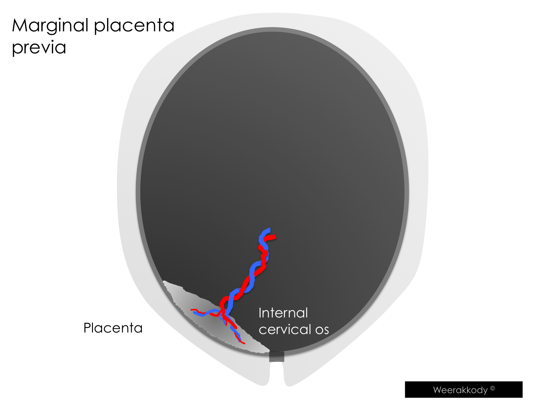 Zonary Placenta Anatomy