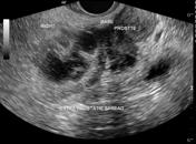 prostatitis ultrasound)