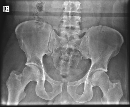 Open book pelvic injury | Radiology Reference Article | Radiopaedia.org