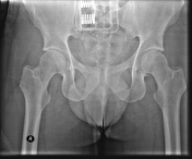 Open book pelvic injury, Radiology Reference Article