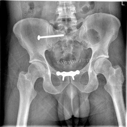 Open Book Pelvic Fracture Diagram