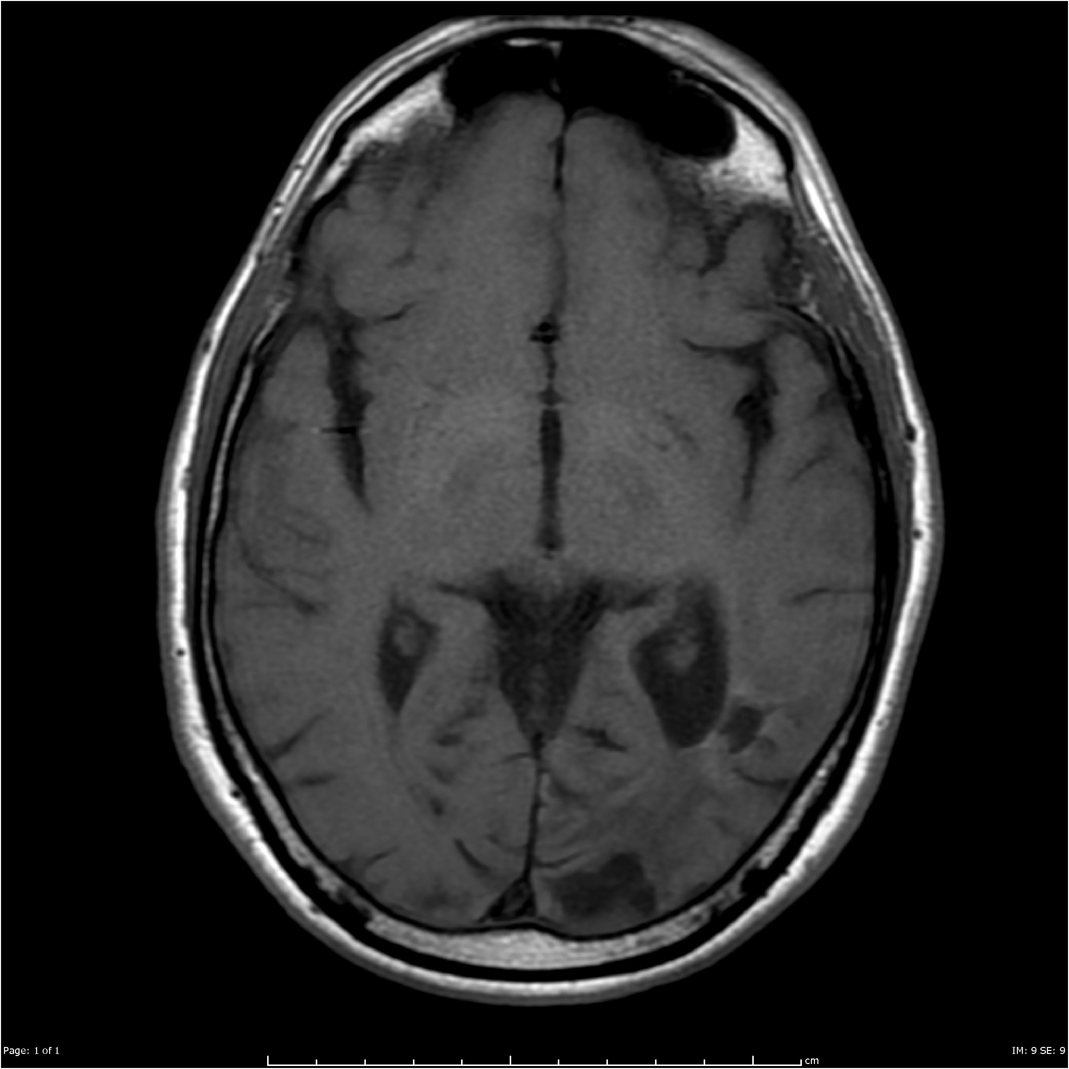 Cerebral Amyloid Angiopathy | Image | Radiopaedia.org