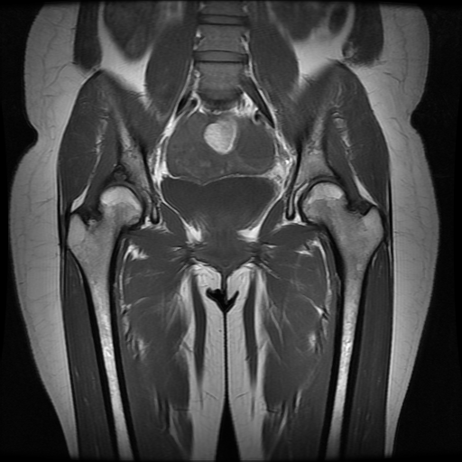 Primary Cystic Arthrosis Of The Hip 