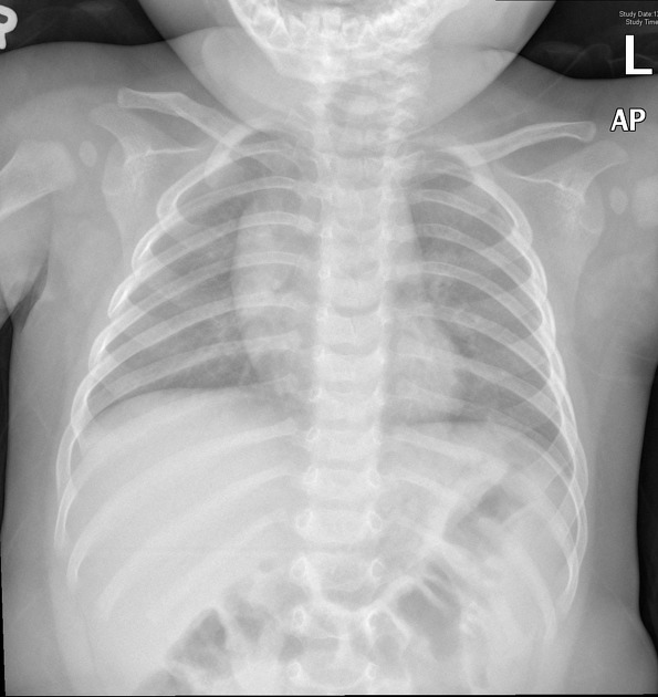 Steeple sign (trachea), Radiology Reference Article