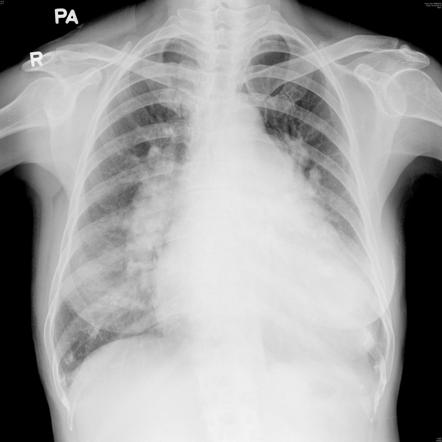 Eisenmenger syndrome | Radiology Reference Article | Radiopaedia.org