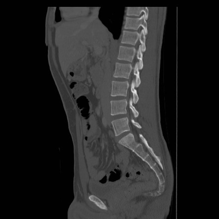 Anterior angulation of the coccyx | Image | Radiopaedia.org