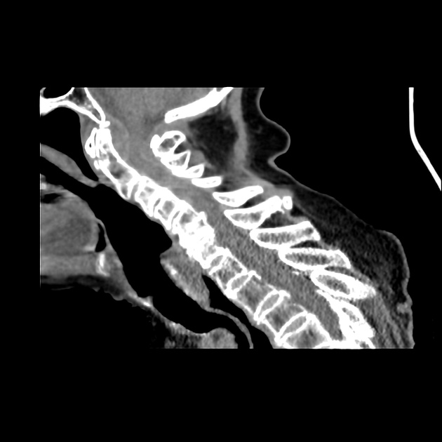 Epidural spinal cord compression scale