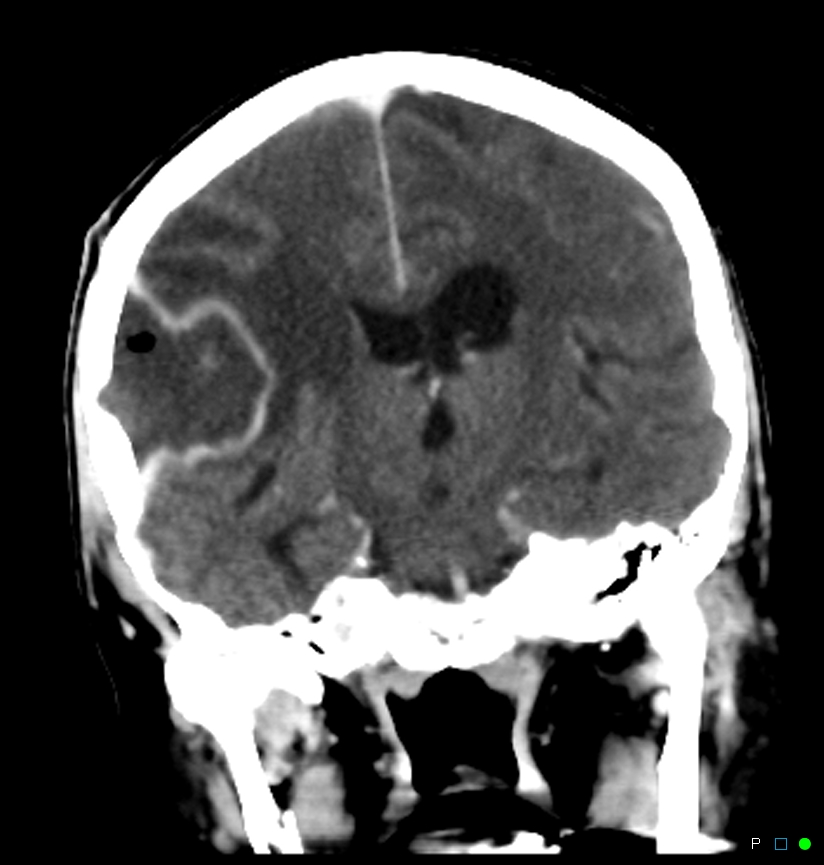 Infected bone flap post craniotomy | Image | Radiopaedia.org