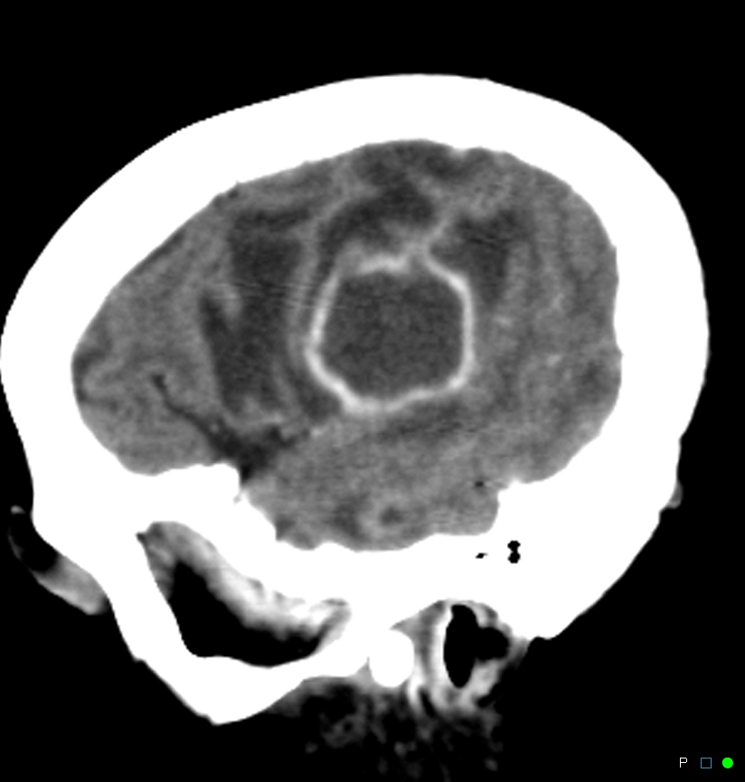 Infected bone flap post craniotomy | Image | Radiopaedia.org