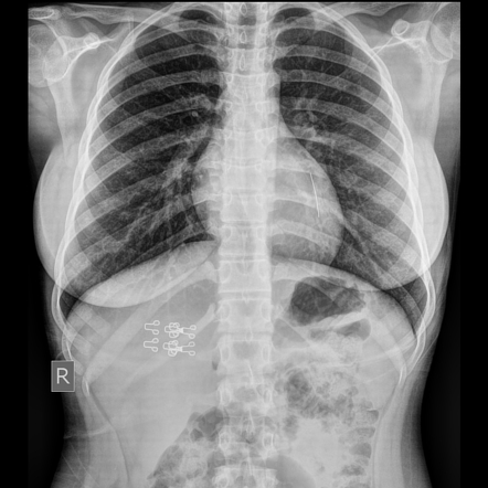 Foreign body in the left lower lobe lung bronchus | Radiology Case ...