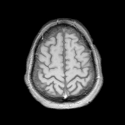 Amyotrophic Lateral Sclerosis Image 0779