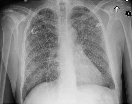 Miliary Tuberculosis X Ray