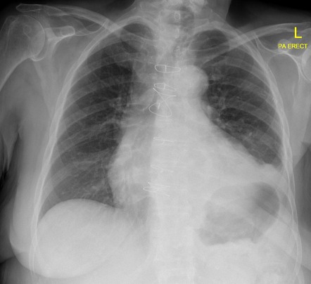 Phrenic nerve palsy | Radiology Reference Article | Radiopaedia.org