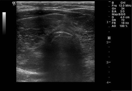 Heterogeneous Thyroid Echotexture Radiology Reference Article Radiopaedia Org