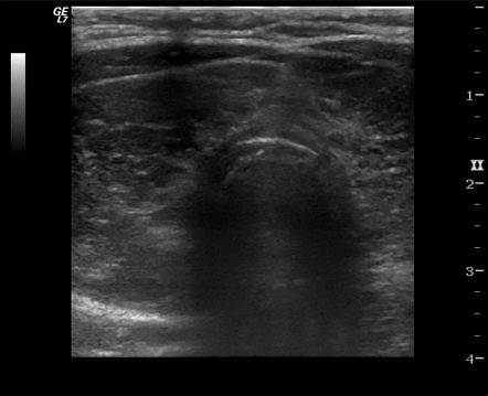 Thyroid Isthmus Ultrasound