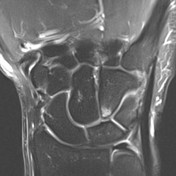 Ulnar-sided wrist impaction and impingement syndromes | Radiology ...