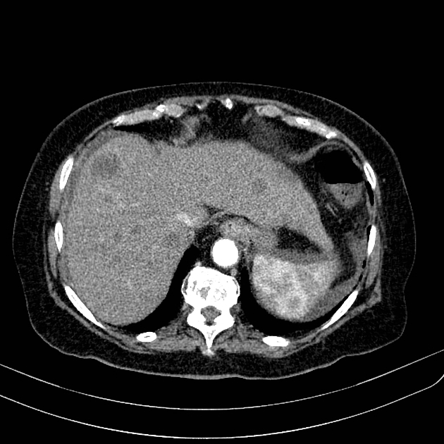 CT & Ultrasound Guided Biopsies